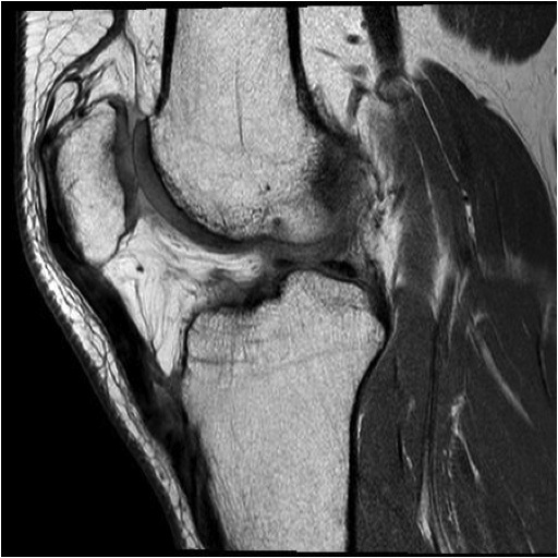 MRI Chronic Quadriceps Rupture